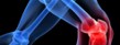 Knee Replacement Surgery